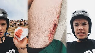 i cut my leg in spain...