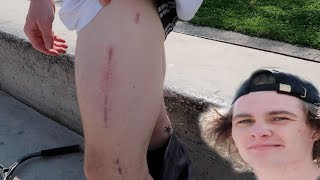 HE BROKE HIS FEMUR..