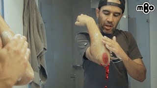 5 Pasos para Curar Heridas de Ciclismo
