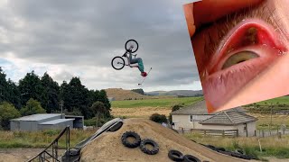 I Crashed And Got A Rock Stuck Behind My Eye!!...