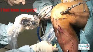 I finally had my Knee Surgery!