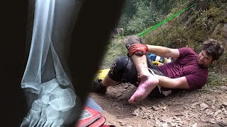 Broke My Ankle Downhill Mountain Biking (Graphic)