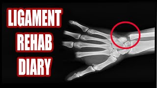 TORN Wrist Ligaments | My Exercises &...