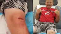 Mountain Bike Crash - 11 stitches